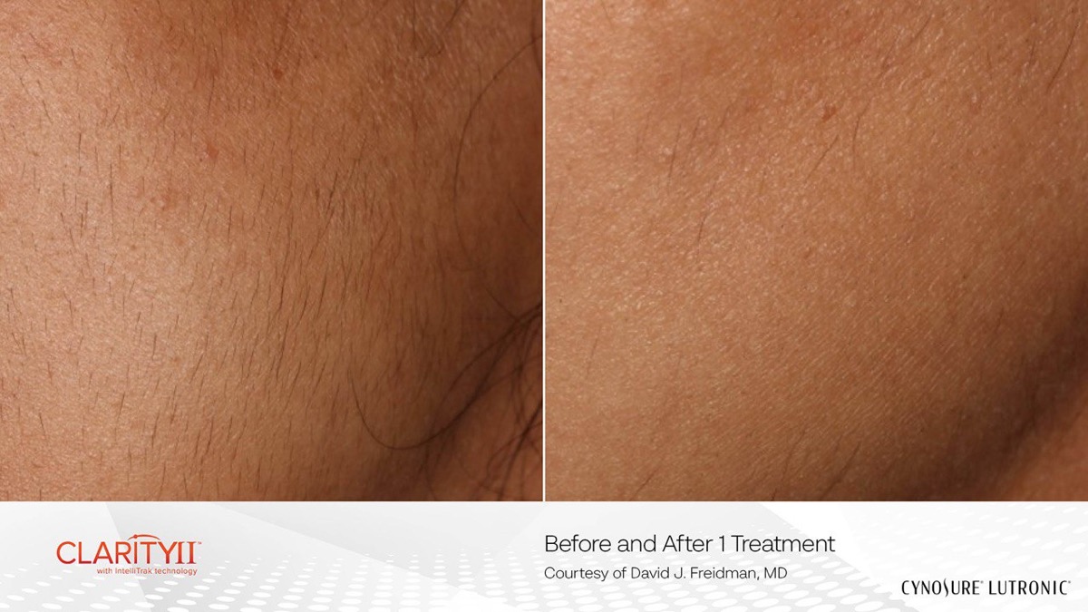 Bikini area laser hair removal before and after on dark skin tone with Cynosure Clarity II