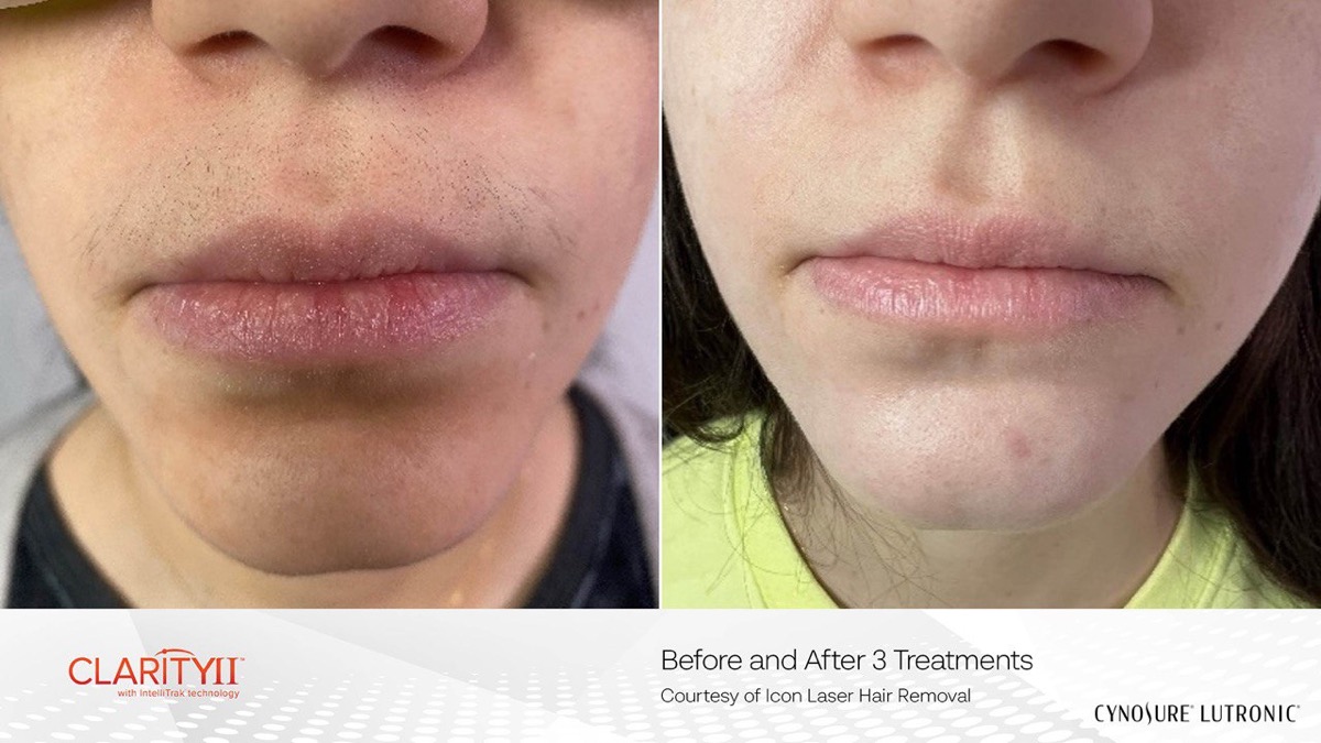 Facial hair laser removal before and after 3 treatments with Cynosure Clarity II on darker skin tone