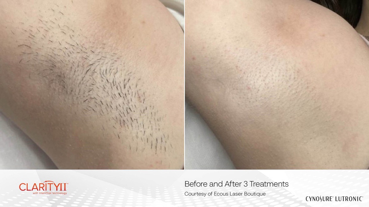 Underarm laser hair removal before and after 3 treatments with Cynosure Clarity II